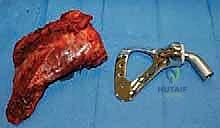 صورة توضيحية لـ إعادة بناء الأطراف الاصطناعية الداخلية: أمل جديد لمرضى أورام العظام مع الأستاذ الدكتور محمد هطيف