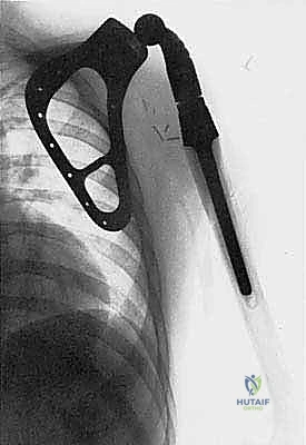 إعادة بناء الأطراف الاصطناعية الداخلية: أمل جديد لمرضى أورام العظام مع الأستاذ الدكتور محمد هطيف