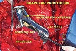 صورة توضيحية لـ إعادة بناء الأطراف الاصطناعية الداخلية: أمل جديد لمرضى أورام العظام مع الأستاذ الدكتور محمد هطيف