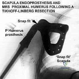صورة توضيحية لـ إعادة بناء الأطراف الاصطناعية الداخلية: أمل جديد لمرضى أورام العظام مع الأستاذ الدكتور محمد هطيف