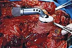 صورة توضيحية لـ إعادة بناء الأطراف الاصطناعية الداخلية: أمل جديد لمرضى أورام العظام مع الأستاذ الدكتور محمد هطيف