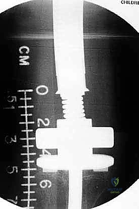 صورة طبية: إعادة بناء الأطراف الاصطناعية الداخلية: أمل جديد لمرضى أورام العظام مع الأستاذ الدكتور محمد هطيف