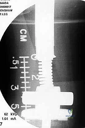 صورة طبية: إعادة بناء الأطراف الاصطناعية الداخلية: أمل جديد لمرضى أورام العظام مع الأستاذ الدكتور محمد هطيف