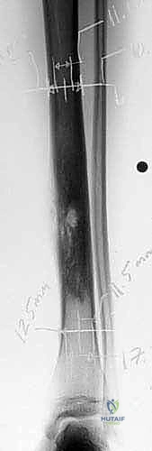 صورة طبية: إعادة بناء الأطراف الاصطناعية الداخلية: أمل جديد لمرضى أورام العظام مع الأستاذ الدكتور محمد هطيف