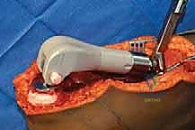 صورة توضيحية لـ إعادة بناء الأطراف الاصطناعية الداخلية: أمل جديد لمرضى أورام العظام مع الأستاذ الدكتور محمد هطيف