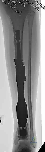 صورة توضيحية لـ إعادة بناء الأطراف الاصطناعية الداخلية: أمل جديد لمرضى أورام العظام مع الأستاذ الدكتور محمد هطيف