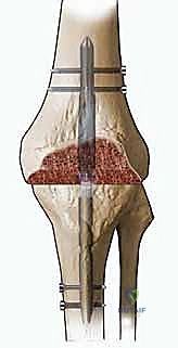 دمج مفصل الركبة (تثبيت الركبة): الحل الأمثل للحالات المعقدة
