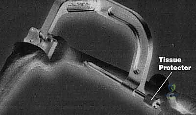 دمج مفصل الركبة (تثبيت الركبة): الحل الأمثل للحالات المعقدة واستعادة الحركة في صنعاء مع الأستاذ الدكتور محمد هطيف