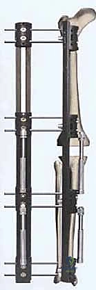 صورة توضيحية لـ دمج مفصل الركبة (تثبيت الركبة): الحل الأمثل للحالات المعقدة واستعادة الحركة في صنعاء مع الأستاذ الدكتور محمد هطيف