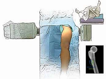 صورة طبية: دمج مفصل الركبة (تثبيت الركبة): الحل الأمثل للحالات المعقدة واستعادة الحركة في صنعاء مع الأستاذ الدكتور محمد هطيف