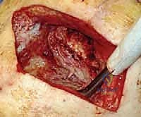 صورة توضيحية لـ دمج مفصل الركبة (تثبيت الركبة): الحل الأمثل للحالات المعقدة واستعادة الحركة في صنعاء مع الأستاذ الدكتور محمد هطيف