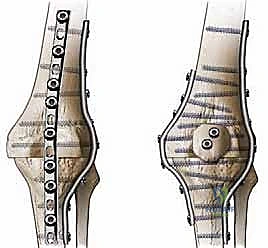 مقارنة الخيارات العلاجية لإنقاذ الطرف السفلي