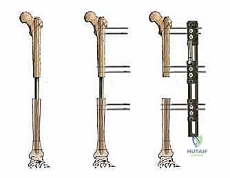 التشريح المعقد لمفصل الركبة وتأثير الإصابات عليه