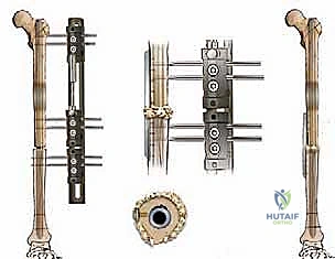 Illustration of femur and tibia - Dr. Mohammed Hutaif