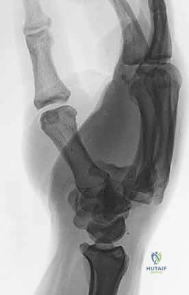 صورة توضيحية لـ دليلك الشامل لكسور وخلع مفصل قاعدة الإصبع الكربوميتاكاربال: التشخيص والعلاج مع الأستاذ الدكتور محمد هطيف