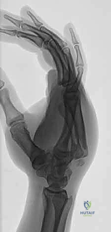 المضاعفات الناتجة عن تأخر العلاج والتشوه العظمي