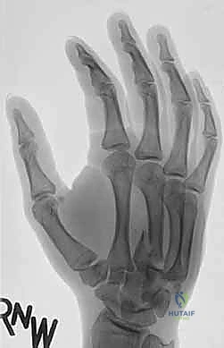 ديناميكية حركة مفاصل الكربوميتاكاربال