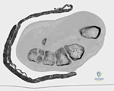 الرد المغلق واستخدام الجبائر في الحالات البسيطة