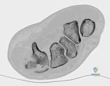استخدام أسلاك كيرشنر والشرائح الدقيقة للتثبيت
