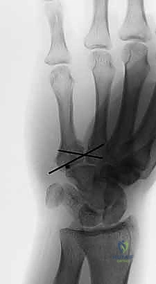 الإغلاق التجميلي للجرح ووضع الجبيرة