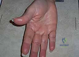 التصوير الإشعاعي الدقيق للتمييز بين الإصابات