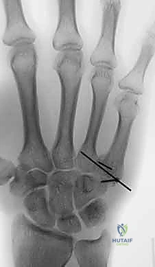 دليلك الشامل لكسور وخلع مفصل قاعدة الإصبع الكربوميتاكاربال: التشخيص والعلاج مع الأستاذ الدكتور محمد هطيف