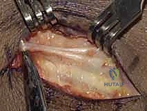 صورة توضيحية لـ دليلك الشامل لكسور وخلع مفصل قاعدة الإصبع الكربوميتاكاربال: التشخيص والعلاج مع الأستاذ الدكتور محمد هطيف