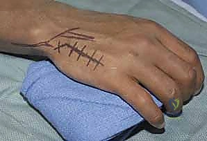 الشق الجراحي الدقيق والحفاظ على الأنسجة