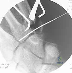 تمارين العلاج الطبيعي واستعادة حركة اليد