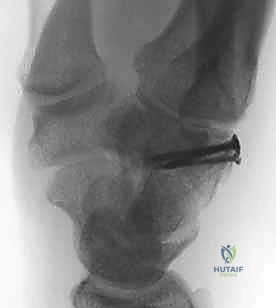 إعادة العظام والمفاصل إلى وضعها التشريحي