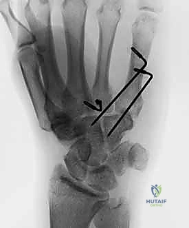 آلية حدوث الإصابة في مفصل قاعدة الإصبع