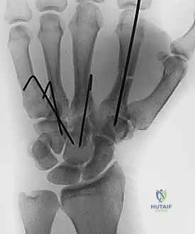 صورة توضيحية لـ دليلك الشامل لكسور وخلع مفصل قاعدة الإصبع الكربوميتاكاربال: التشخيص والعلاج مع الأستاذ الدكتور محمد هطيف