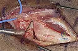 صورة توضيحية لـ دليلك الشامل لكسور وخلع مفصل قاعدة الإصبع الكربوميتاكاربال: التشخيص والعلاج مع الأستاذ الدكتور محمد هطيف