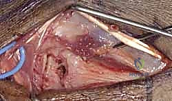 صورة طبية: دليلك الشامل لكسور وخلع مفصل قاعدة الإصبع الكربوميتاكاربال: التشخيص والعلاج مع الأستاذ الدكتور محمد هطيف