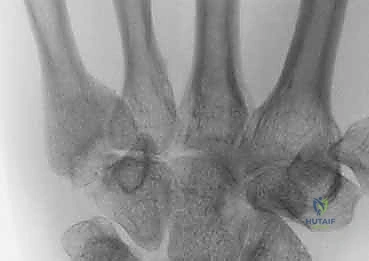 Illustration of ring and small - Dr. Mohammed Hutaif