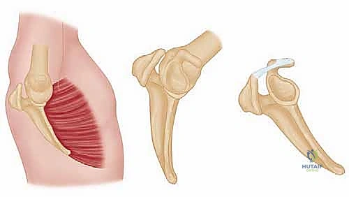 التخطيط الجراحي الدقيق قبل بدء عملية نقل العضلة الصدرية الكبرى