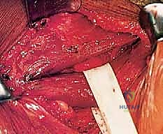 تحضير الرقعة النسيجية وتثبيتها بالعضلة الصدرية لإطالتها