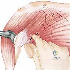 نقل العضلة الصدرية الكبرى لعلاج شلل العصب الصدري الطويل (الجناح الكتفي): دليل شامل للمرضى مع الأستاذ الدكتور محمد هطيف