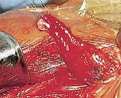 صورة توضيحية لـ نقل العضلة الصدرية الكبرى لعلاج شلل العصب الصدري الطويل (الجناح الكتفي): دليل شامل للمرضى مع الأستاذ الدكتور محمد هطيف