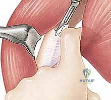 صورة توضيحية لـ نقل العضلة الصدرية الكبرى لعلاج شلل العصب الصدري الطويل (الجناح الكتفي): دليل شامل للمرضى مع الأستاذ الدكتور محمد هطيف