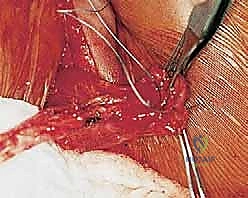 صورة توضيحية لـ نقل العضلة الصدرية الكبرى لعلاج شلل العصب الصدري الطويل (الجناح الكتفي): دليل شامل للمرضى مع الأستاذ الدكتور محمد هطيف