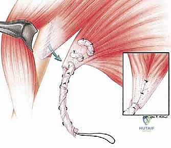 صورة توضيحية لـ نقل العضلة الصدرية الكبرى لعلاج شلل العصب الصدري الطويل (الجناح الكتفي): دليل شامل للمرضى مع الأستاذ الدكتور محمد هطيف