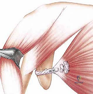 صورة توضيحية لـ نقل العضلة الصدرية الكبرى لعلاج شلل العصب الصدري الطويل (الجناح الكتفي): دليل شامل للمرضى مع الأستاذ الدكتور محمد هطيف