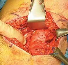 صورة توضيحية لـ إصلاح انفصال أوتار الركبة الخلفية القريب: دليلك الشامل مع الأستاذ الدكتور محمد هطيف في صنعاء