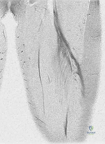 صورة توضيحية لـ إصلاح انفصال أوتار الركبة الخلفية القريب: دليلك الشامل مع الأستاذ الدكتور محمد هطيف في صنعاء