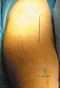 إصلاح انفصال أوتار الركبة الخلفية القريب: دليلك الشامل مع الأستاذ الدكتور محمد هطيف في صنعاء