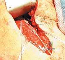 صورة توضيحية لـ إصلاح انفصال أوتار الركبة الخلفية القريب: دليلك الشامل مع الأستاذ الدكتور محمد هطيف في صنعاء