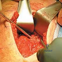 صورة توضيحية لـ إصلاح انفصال أوتار الركبة الخلفية القريب: دليلك الشامل مع الأستاذ الدكتور محمد هطيف في صنعاء