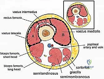صورة توضيحية لـ ساركوما العضلة الرباعية: دليل شامل لجراحة إنقاذ الطرف والعلاج المتقدم