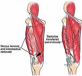 صورة طبية: ساركوما العضلة الرباعية: دليل شامل لجراحة إنقاذ الطرف والعلاج المتقدم